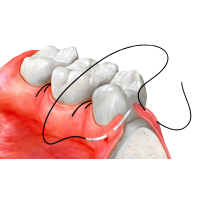 Шовный материал для стоматологии